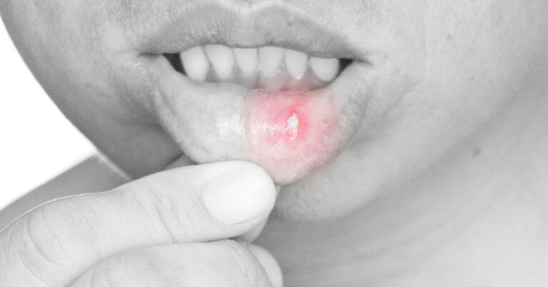 Aphtes : 7 astuces simples pour les éviter et les soulager rapidement